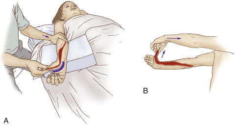 Gentle self-care (and therapist-assisted) stretch for De Quervain’s Syndrome. Permission: Joseph E. Muscolino, The Muscle and Bone Palpation Manual (2016), Elsevier.