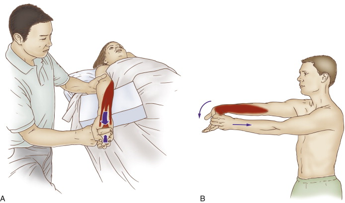 Self-care (and therapist-assisted) stretch for golfer’s elbow. Permission: Joseph E. Muscolino, The Muscle and Bone Palpation Manual (2016), Elsevier.