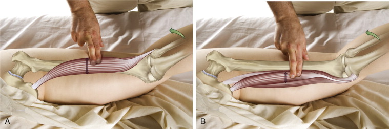 Cross fiber work to the biceps femoris and semitendinosus muscles of the hamstring group. Permission: Joseph E. Muscolino. The Muscle and Bone Palpation Manual, 2ed (2016), Elsevier.