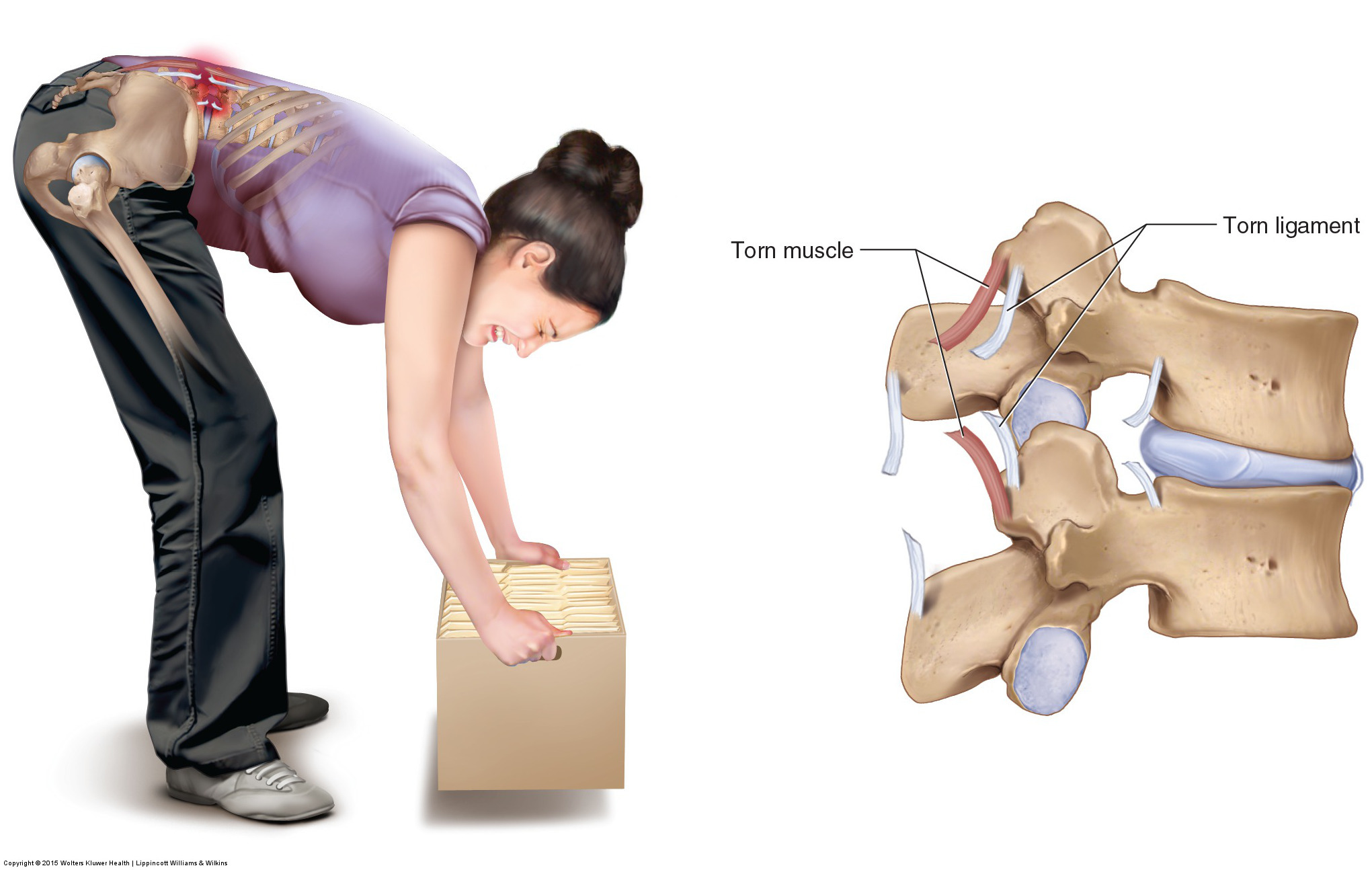 Bending forward to pick up an object is a common cause of low back strains and sprains. Permission: Joseph E. Muscolino. Manual Therapy for the Low Back and Pelvis (2015).