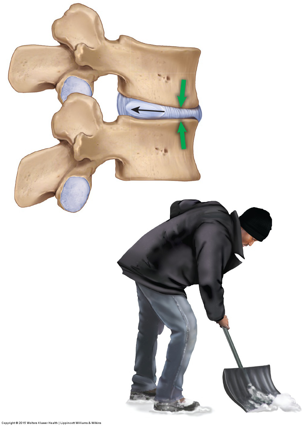 Flexion drives the nucleus pulposus posteriorly against the annulus fibrosus of the disc. Permission: Joseph E. Muscolino. Manual Therapy for the Low Back and Pelvis (2015).