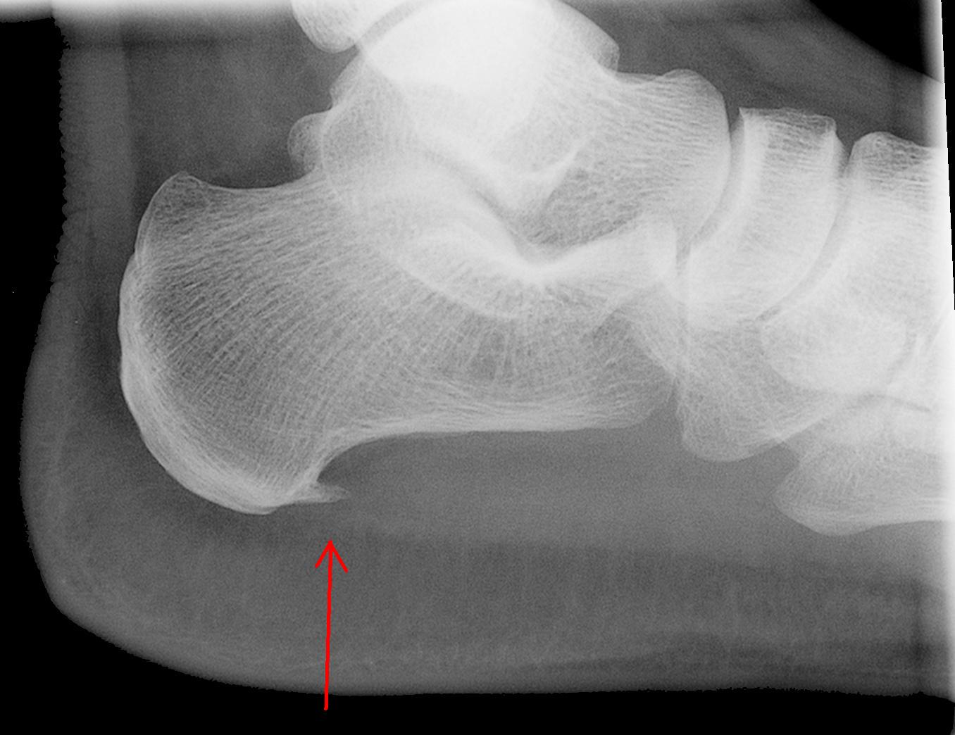 A heel spur on the underside of the calcaneus. 
