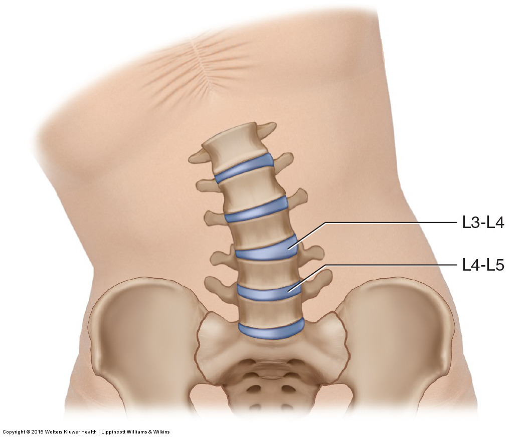 A hypomobile joint dysfunction at L4-L5 creates a hypermobile joint dysfunction at L3-L4. Permission: Joseph E. Muscolino. Manual Therapy for the Low Back and Pelvis (2015).