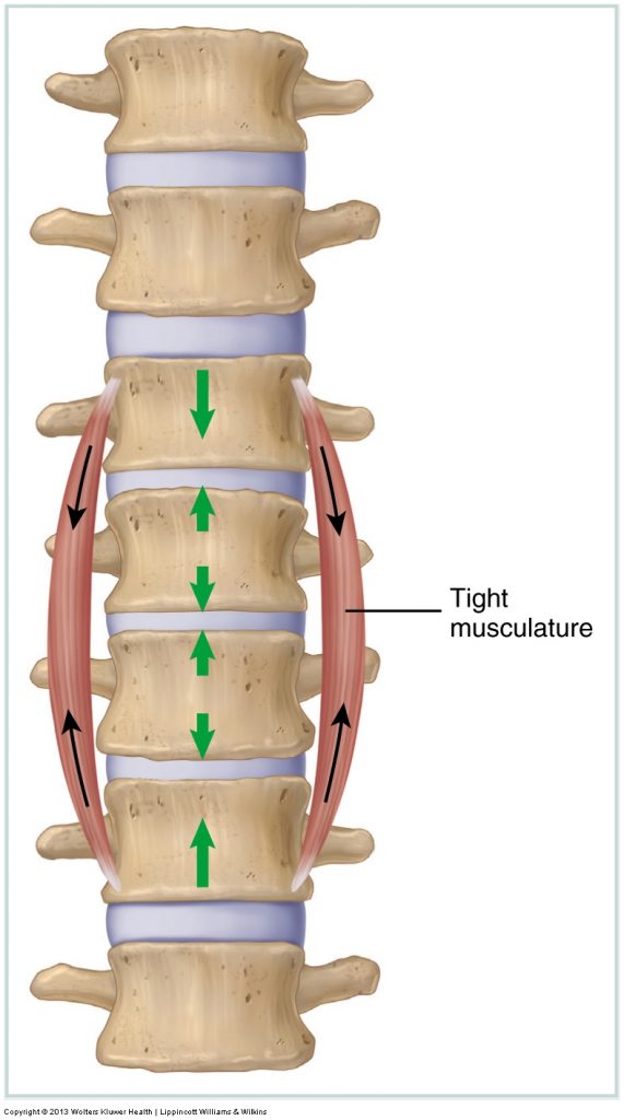 Tight musculature compresses joints