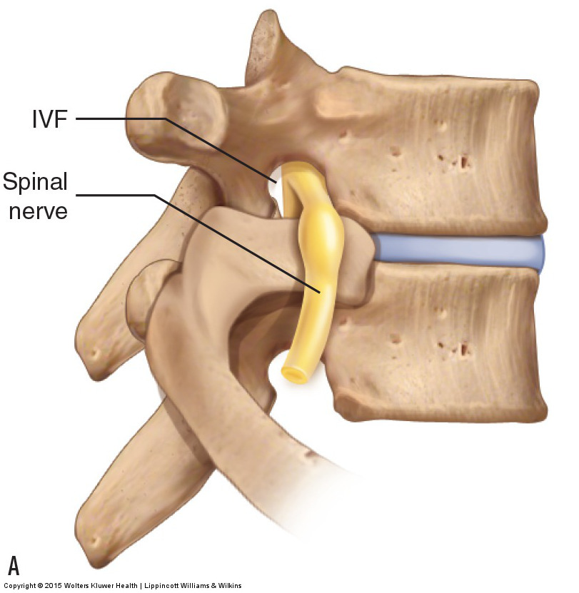 A pinched spinal nerve in the intervertebral foramen