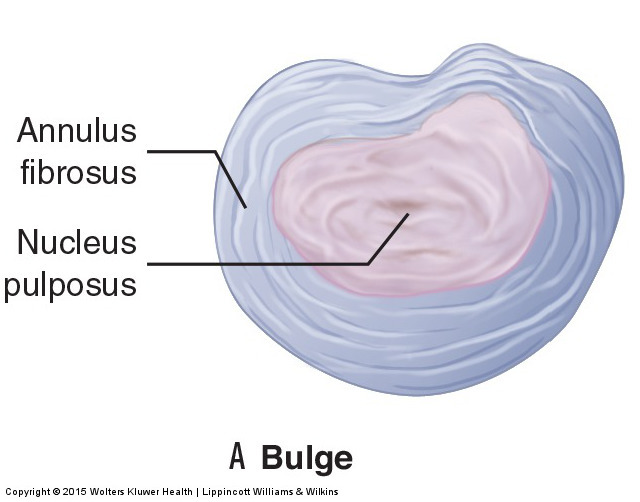 pathologic discs: bulging, herniated, sequestered