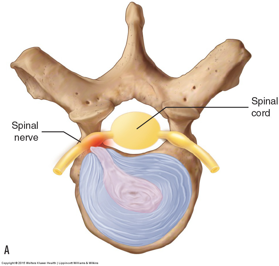 Disc Herniations: Posterolateral and Midline.