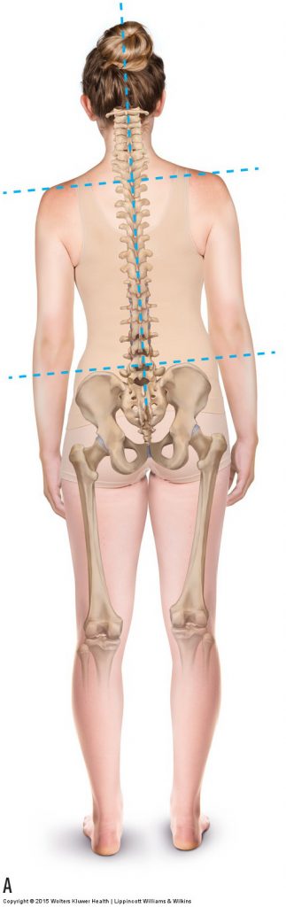 An unlevel iliac crest height that is uncompensated