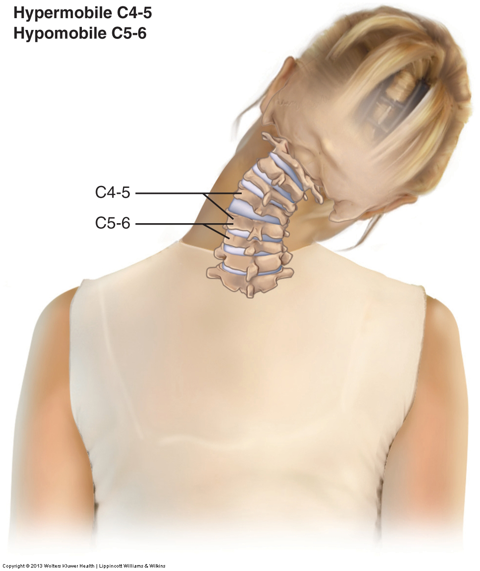 Dysfunksjon i cervikal ryggraden