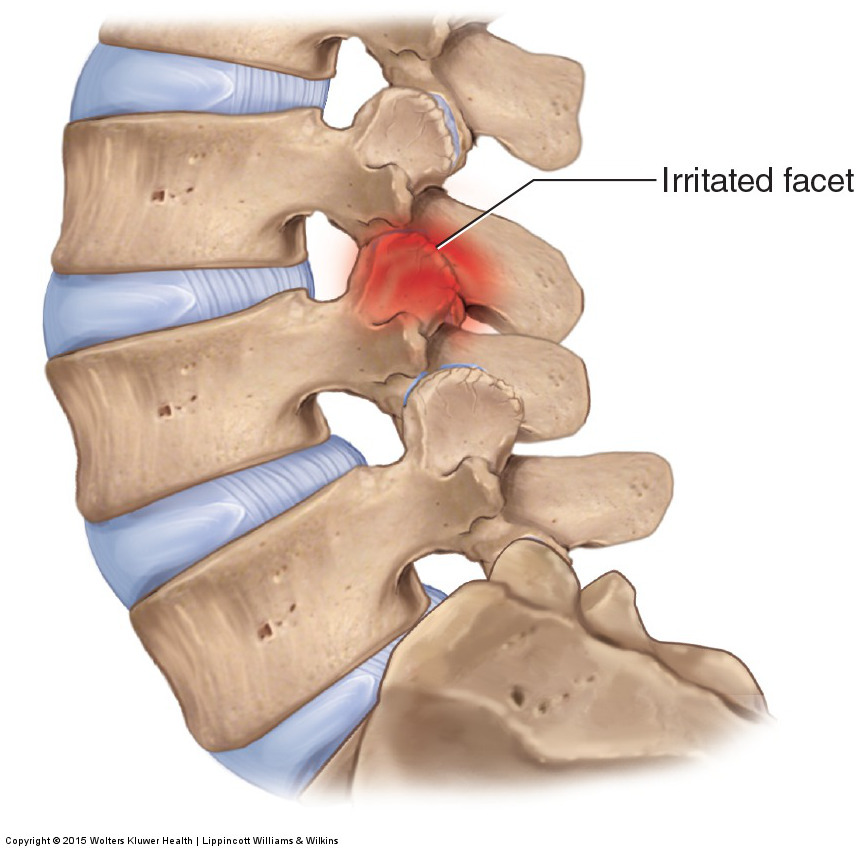 excessive posterior loading of the lumbar spine leads to facet syndrome